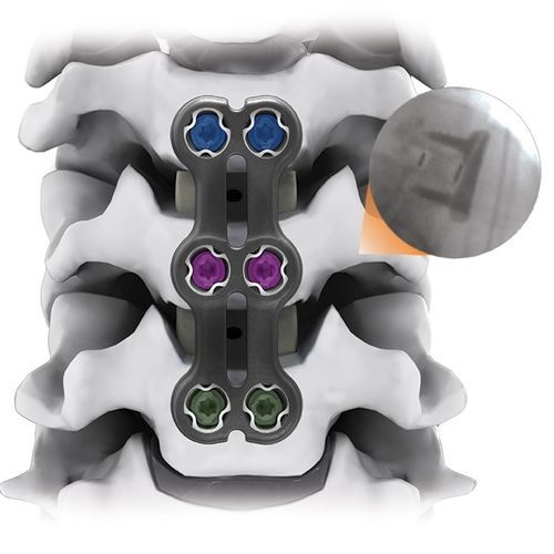 Костная пластина для артродеза для шейного позвонка - IRIS® - Life Spine - блокируемая / 2 уровня