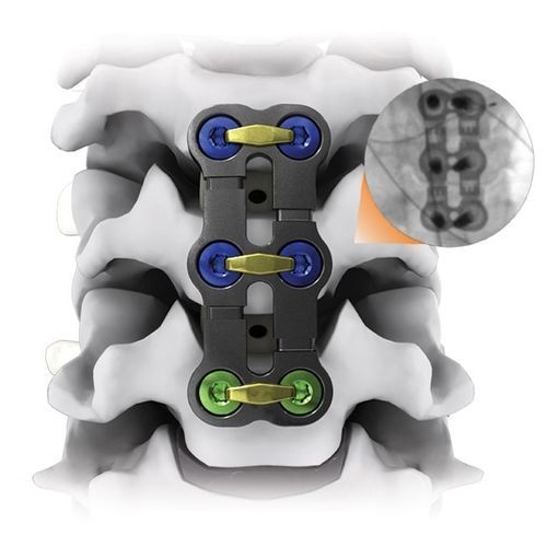 Костная пластина для артродеза шеи - KINETIC® - Life Spine - блокируемая / металлическая / 2 уровня