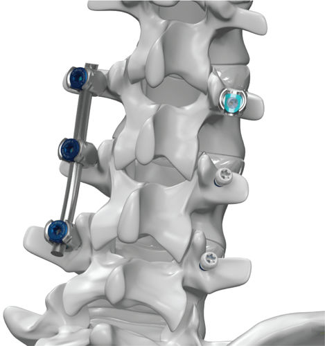 Система остеосинтеза для грудо-поясничной зоны - ARx® - Life Spine - через задний отдел