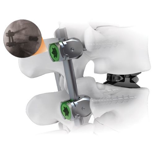 Система остеосинтеза для грудо-поясничной зоны - CENTERLINE® - Life Spine - через задний отдел