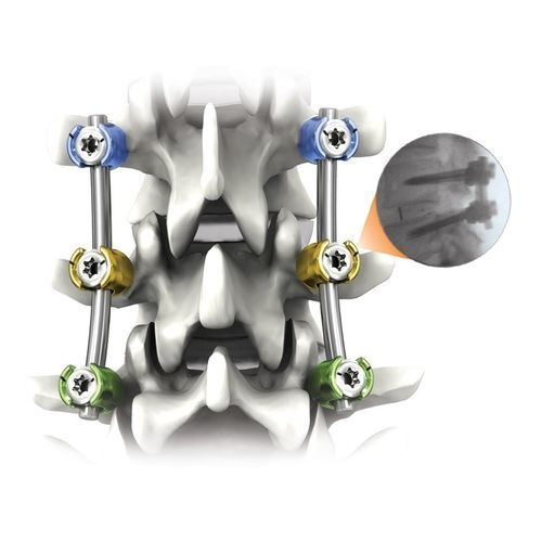 Система остеосинтеза для грудо-поясничной зоны - NAUTILUS® - Life Spine - через задний отдел