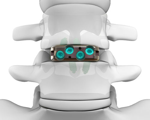 Межтеловой кейдж для поясничной зоны - DYNA-LINK® ELITE - Life Spine - через передний отдел