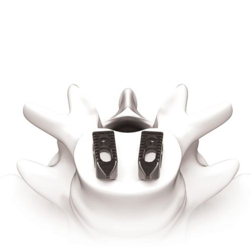 Межтеловой кейдж для грудо-поясничной зоны - PLATEAU®-Ti - Life Spine - через передний отдел / из титана