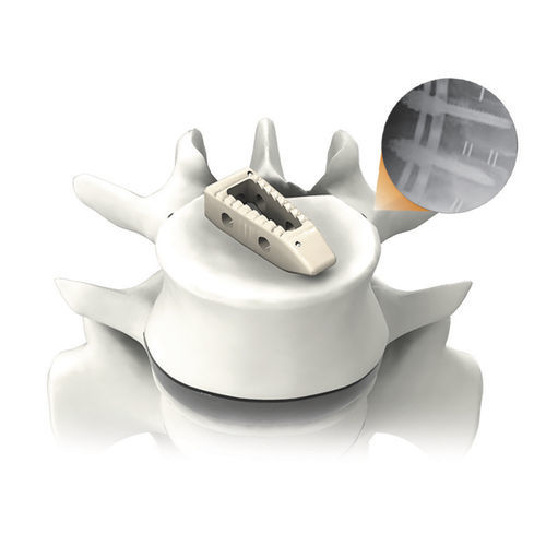 Межтеловой кейдж для грудо-поясничной зоны - PLATEAU®-P - Life Spine - через задний отдел / из ПЭЭК