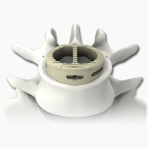 Межтеловой кейдж для поясничной зоны - PLATEAU®-A - Life Spine - через передний отдел / из ПЭЭК