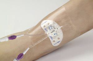 Центральный венозный катетер - Xcela® PICC - Navilyst Medical