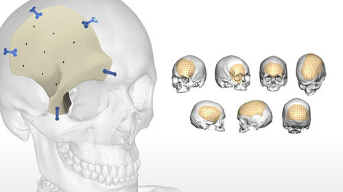 Черепной имплантат на заказ - OsteoMatch™ - Acumed