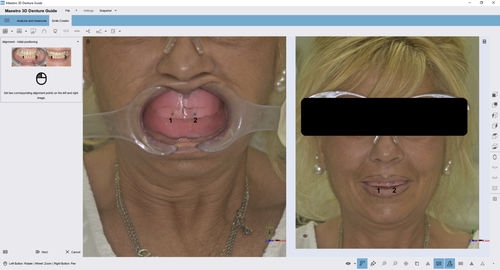 Модуль программного обеспечения для стоматологии - 3D Denture Guide - AGE Solutions - для захвата