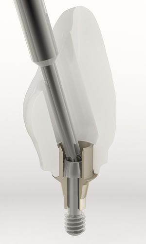 Абатмент из титана - BH - DESS AURUM Base™ - Dess Dental Smart Solutions - наружный шестиугольник / прямой