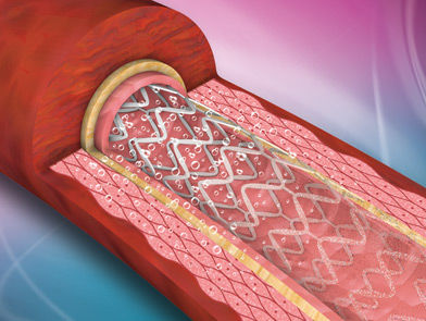 Стент для коронарных артерий - ReNATURAL - Cardionovum - из металла / саморассасывающийся