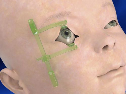 Пальпебральный ранорасширитель - Neotech Products - педиатрический / одноразового применения