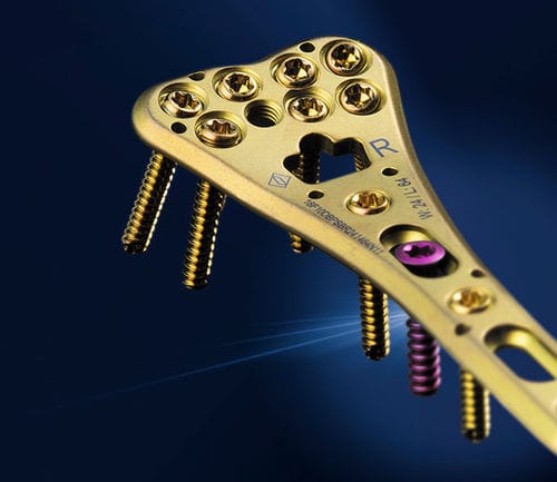 Компрессионная костная пластина лучевая кость - SIGNEX - OSTEONIC - дистальная / блокируемая / металлическая