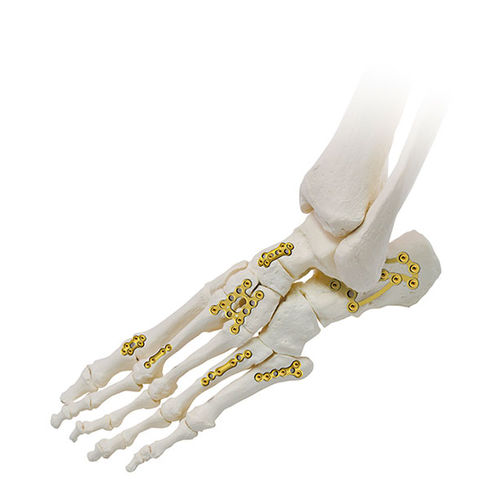 Компрессионная костная пластина ступня - SIGNEX - OSTEONIC - блокируемая / металлическая