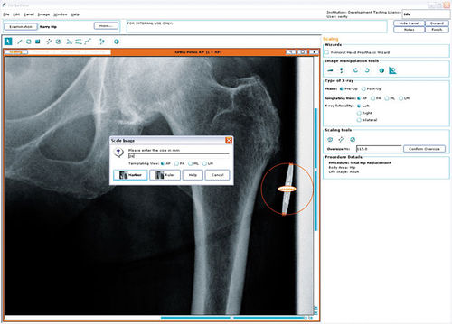Программное обеспечение для предоперационного планирования - Hip Arthroplasty - OrthoView - для хирургии тазобедренного сустава / для ортопедической хирургии / медицинское