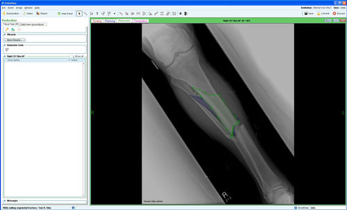 Модуль программного обеспечения для управления - Fracture Management - OrthoView - для планирования / для ортопедической хирургии