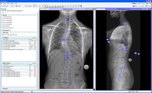 Модуль программного обеспечения для управления - Spinal Deformity Assessment - OrthoView - для предоперационного планирования / для ортопедической хирургии / позвоночник
