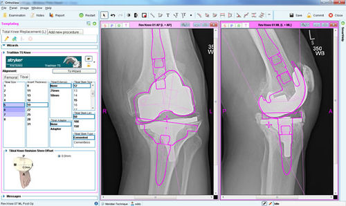 Программное обеспечение для предоперационного планирования - Knee Arthroplasty - OrthoView - для хирургии коленного состава