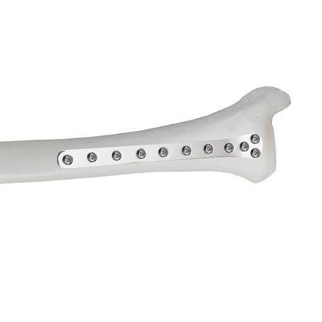 Компрессионная костная пластина большеберцовая кость - 37.804.0 series - Medicalex - дистальная / блокируемая / металлическая