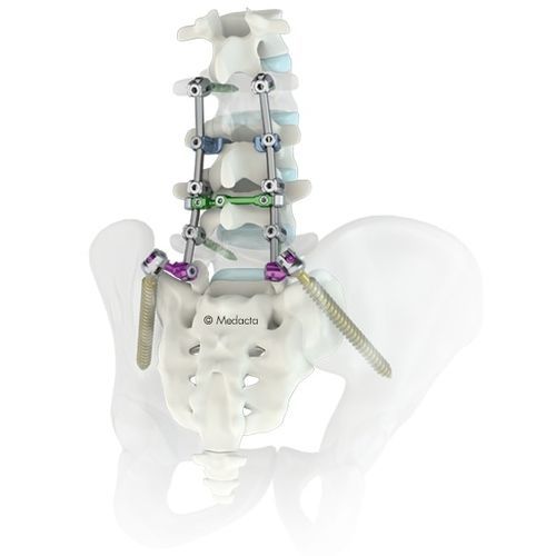 Система остеосинтеза для пояснично-крестцовой зоны - M.U.S.T.® - Medacta - через задний отдел