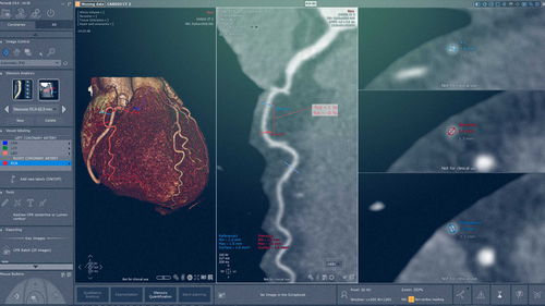Модуль программного обеспечения для кардиологии - Myrian® XP-Cardiac - Intrasense - медицинский / для анализа / для визуализации