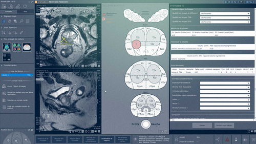 Модуль программного обеспечения для МРТ - Myrian® XP-Prostate - Intrasense - для ультразвуковых исследований / для анализа / для визуализации