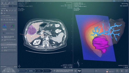 Медицинский модуль программного обеспечения - MYRIAN®XP-LIVER MRI - Intrasense - для анализа / для диагностики / для оценки