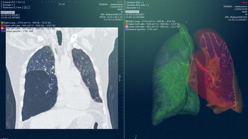 Модуль программного обеспечения для рентгенологии - Myrian® XP-Lung - Intrasense - для хирургии / для анализа / для планирования