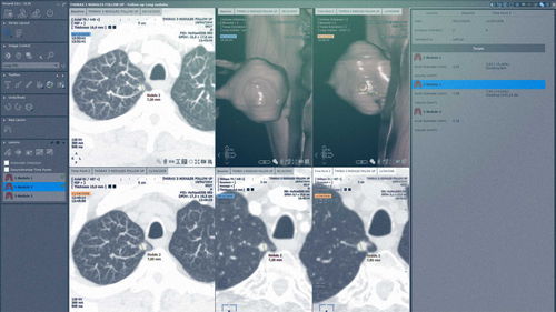 Модуль программного обеспечения для хирургии - MYRIAN®XP-LUNG NODULE - Intrasense - для анализа / для визуализации / для оценки