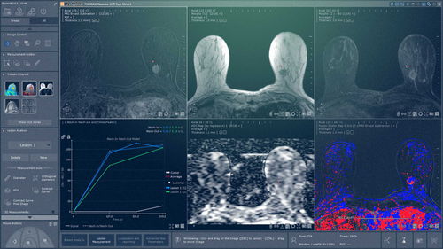 Медицинский модуль программного обеспечения - Myrian® XP-Breast - Intrasense - для маммографии / для анализа / для визуализации