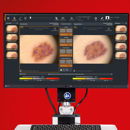Программное обеспечение для исследований - Moleanalyzer pro - FotoFinder Systems - дерматология / для диагностики кожи / с поддержкой ИИ