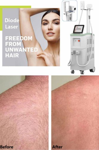 Best brand laser hair removal machine-BVLASER. 808nm diode laser hair removal machine manufacturer