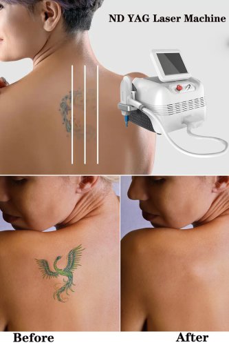 best ND YAG laser machine Q-switched ND YAG laser tattoo removal machine for sale