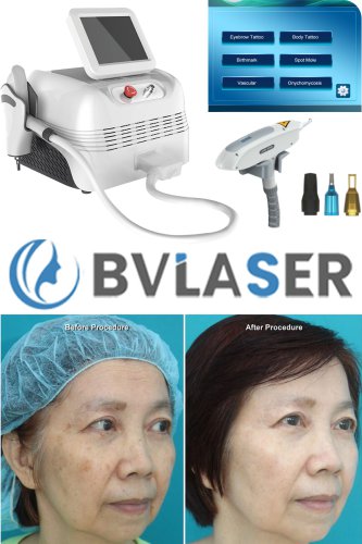 ND YAG laser dermatology Q-switched ND YAG laser tattoo removal machine