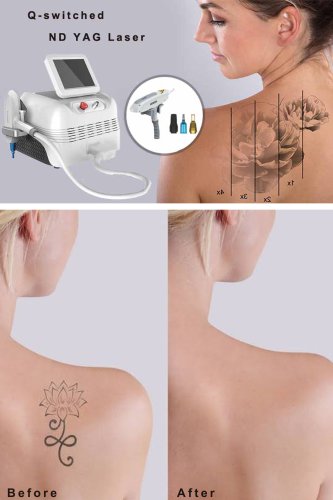 ND YAG laser manufacturer-BVLASER. China Q switched ND YAG laser factory. The best Q-switched ND YAG laser tattoo removal machine.