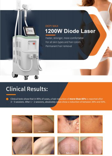 OEM diode laser big spot. BVLASER is a professional diode laser hair removal machine manufacturer