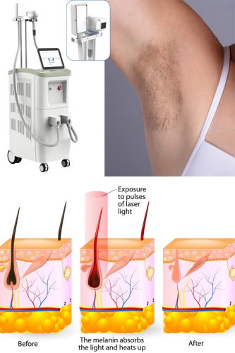 permanent laser hair removal professional laser hair removal machine sale