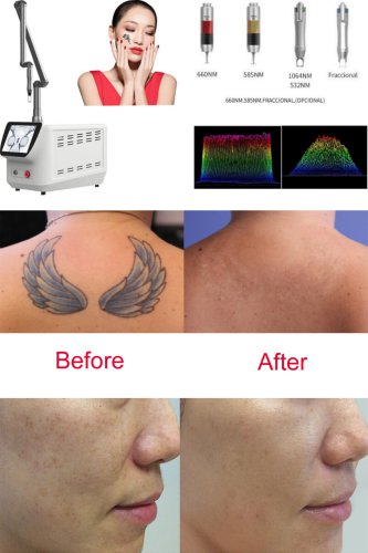 Picosecond Laser Tattoo Removal Machine