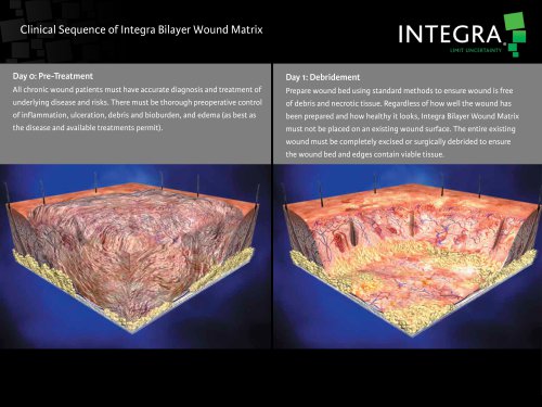 Clinical Sequence of Integra Bilayer Wound Matrix