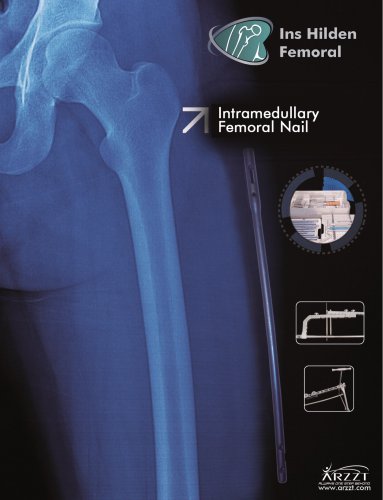 Intramedullary Femoral Nail